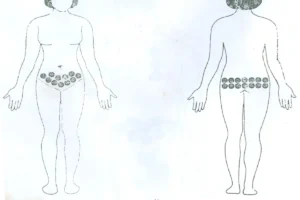 بادکش تخمدان