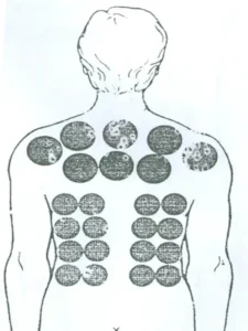 بادکش رماتیسم