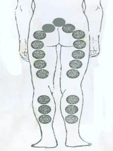 بادکش سیاتیک