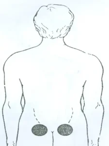 بادکش لغزان کلیه