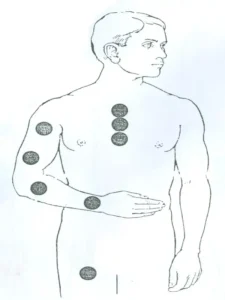 بادکش موضعی