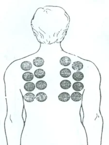 بادکش وسیع ریه