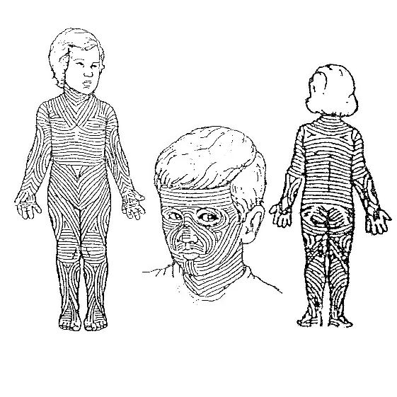 حجامت در طب سنتی