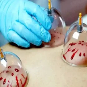 حجامت در طب سنتی