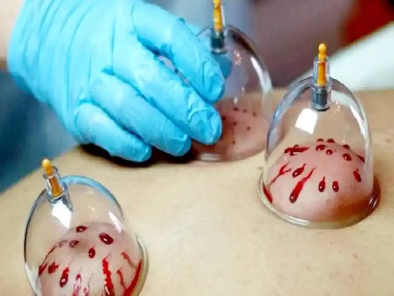 حجامت در طب سنتی