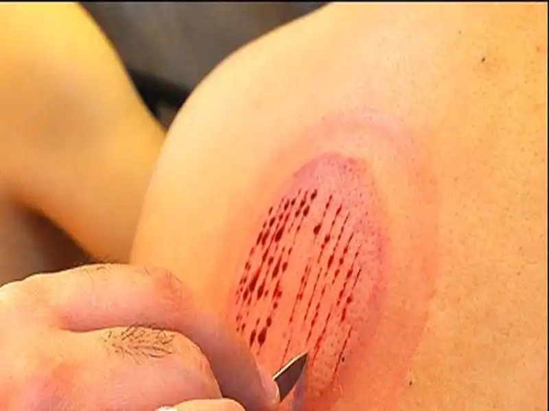 حجامت در طب سنتی